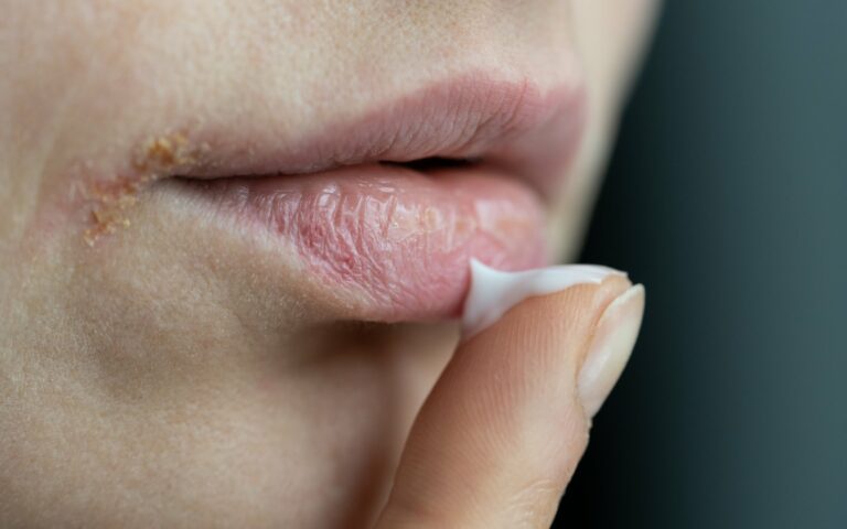 Eine Hand trägt Lippenpflege auf spröde Lippen auf, sichtbar sind trockene Hautstellen.